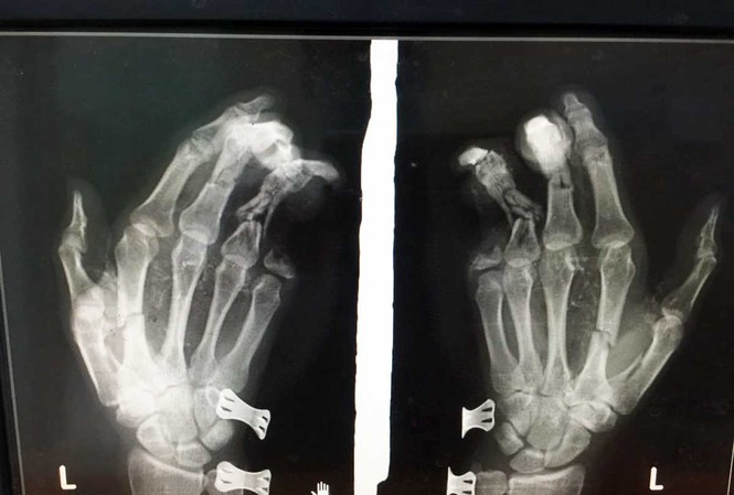 Phim chụp X-quang cho thấy ngón út của bệnh nhân bị mất 2 đốt.