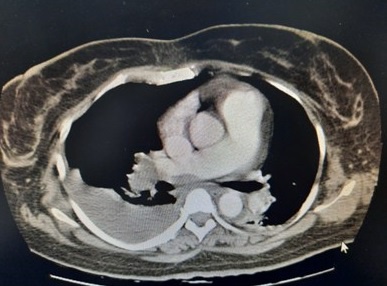 Hình ảnh chụp CT scan ngực có cản quang của người bệnh.