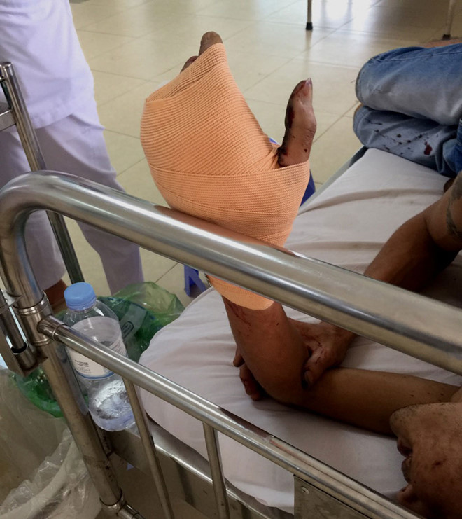 Bệnh nhân dập nát bàn tay đang được điều trị tại bệnh viện.