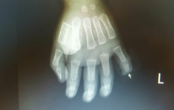 Ảnh phim chụp X-quang bàn tay trái có ngón bị đứt rời của bệnh nhi.