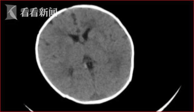 Hình chụp CT cho thấy bệnh nhi bị xuất huyết não.