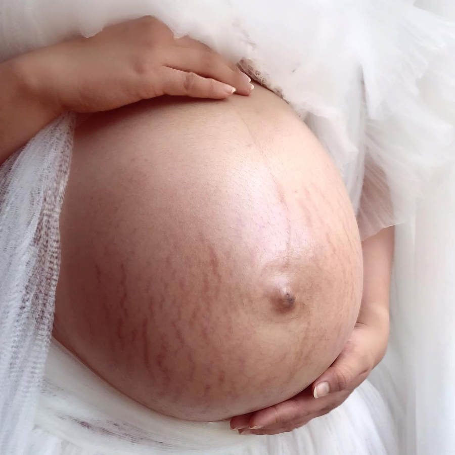 Mang thai đôi nên bụng ngay từ khi hơn 6 tháng, bụng của Đặng Thu Thảo đã lớn như mẹ bầu đơn thai sắp sinh, điều này khiến cô bị rạn nhiều dù đã chăm chỉ bôi kem dưỡng ẩm.