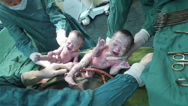 Sau khi đưa được bé thứ nhất ra khỏi bụng mẹ, các bác sĩ phát hiện bé thứ 2 vẫn còn nguyên trong bọc ối. Bác sĩ đã rạch túi nước ối để đưa em bé ra và cắt dây rốn. Hai bé chào đời khỏe mạnh. Hiện sức khỏe của mẹ và bé đã ổn định.