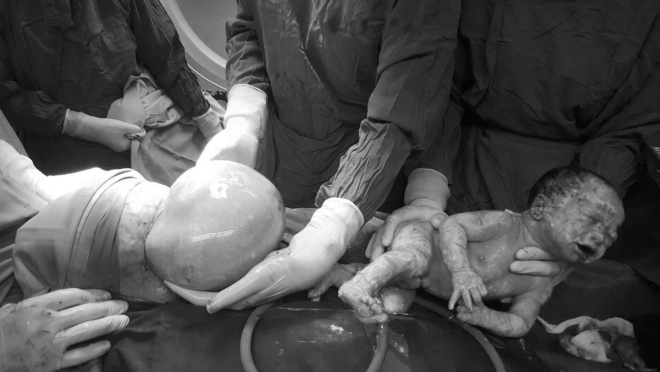Cặp sinh đôi một trai, một gái vừa chào đời ở Quảng Ninh bằng phương pháp sinh mổ. Một trong hai bé vẫn còn nguyên trong bọc ối khi được đưa ra khỏi bụng mẹ.