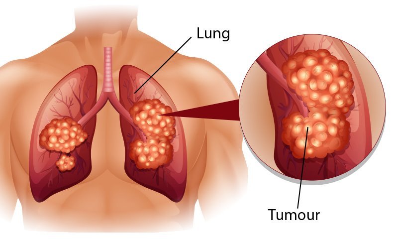 Ung thư phổi có nguy cơ di truyền từ thế hệ trước sang thế hệ sau.