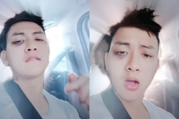 Mới đây, Hoài Lâm bất ngờ chia sẻ đoạn clip ngắn khoảng 15 giây ghi lại khoảnh khắc đời thường đang ngồi trong ô tô di chuyển. Tuy nhiên, điều gây chú ý là biểu cảm của Hoài Lâm cũng như gương mặt có phần khác lạ. Nam ca sĩ khiến người hâm mộ hoang mang khi để lộ 1 phần góc mắt bị sưng và bầm tím. Nhiều người còn chẳng hiểu vì sao bị thương như thế mà Hoài Lâm vẫn thoải mái quay clip. Dường như từ ngày tan vỡ và ở ẩn đến nay, fan chưa thấy được một hình ảnh chỉn chu nào từ Hoài Lâm.