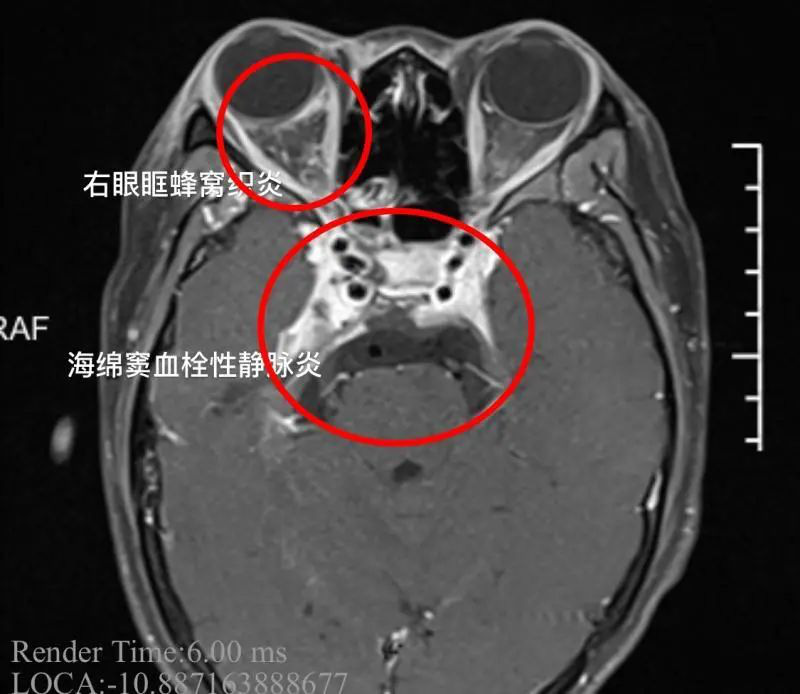 Ảnh chụp CT hộp sọ của bệnh nhân. Vòng tròn đỏ to là khu vực huyết khối xoang hang gây viêm tắc tĩnh mạch. Vòng tròn đỏ nhỏ là ảnh hưởng của viêm tắc tĩnh mạch làm sưng tấy và mắt phải của bệnh nhân không mở được.
