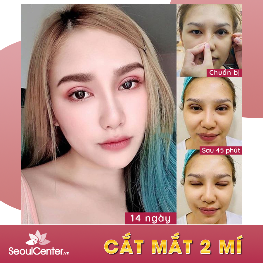 Cắt mí tạo cho đôi mắt to tinh anh, có hồn và có chiều sâu hơn