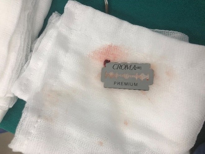 Chiếc dao lam được lấy ra khỏi họng của bệnh nhân.