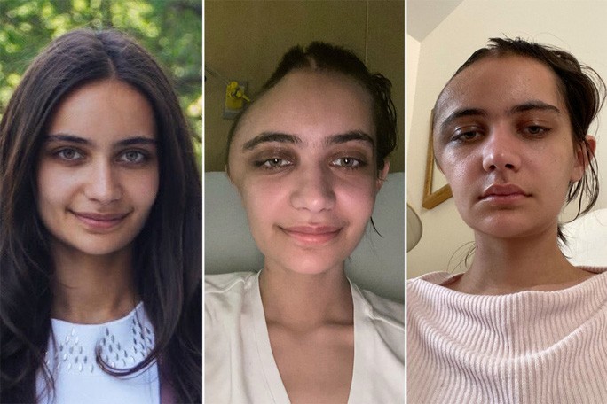 Nạn nhân Annabel Sen trước và sau tai nạn kinh hoàng. Ảnh: NY Post