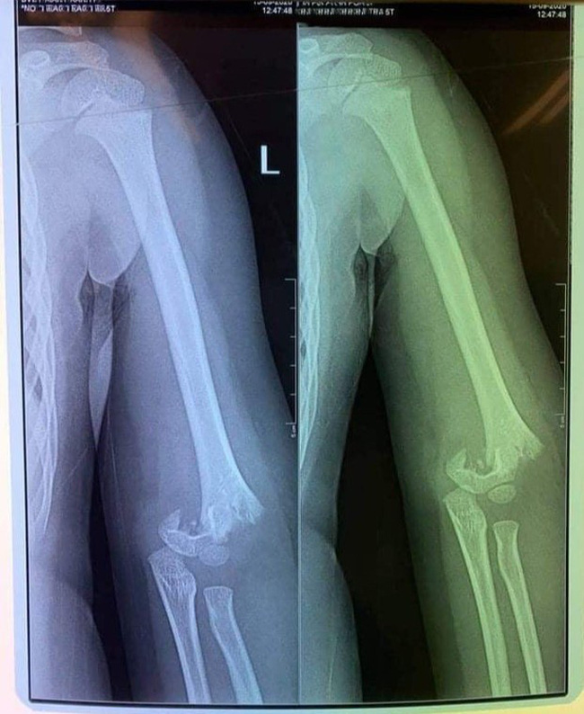 Hình ảnh chụp phim cho thấy trẻ bị gãy xương cánh tay. Ảnh: Gia đình cung cấp.