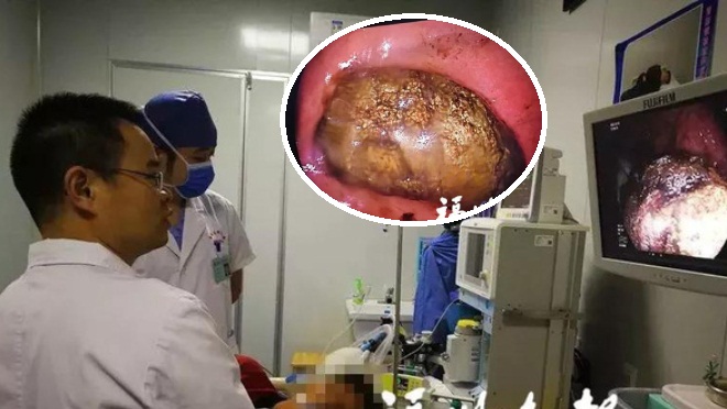 Viên sỏi dạ dày có kích thước lớn trong dạ dày của bệnh nhân.