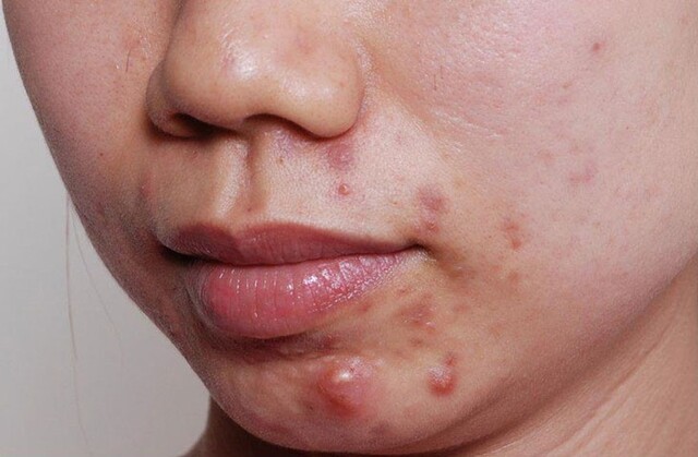 Khuôn mặt chi chít mụn làm ảnh hưởng đến cuộc sống của teen.