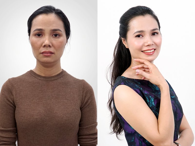 Chị Hải Anh (37 tuổi, Hà Nội) đã trải nghiệm dịch vụ căng chỉ Be Young tại JK Beauty Center