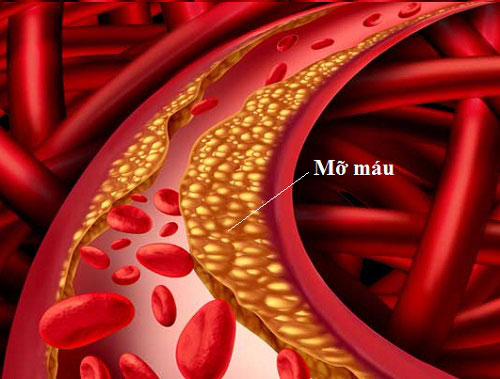 Mỡ trong máu tăng cao làm tăng độ nhớt của máu, gây tắc nghẽn mạch máu.