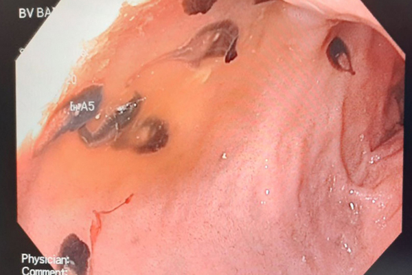 Hình ảnh sán lá gan bám trong ống mật chủ của bệnh nhân.