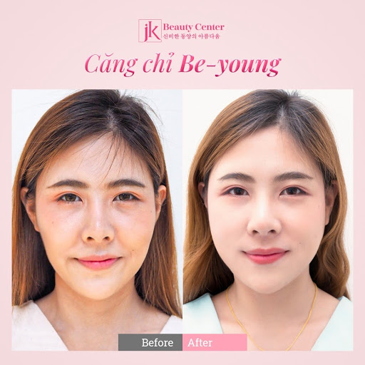Gương mặt chị Thanh Thuỷ căng mịn, trẻ trung tràn đầy sức sống sau khi căng chỉ Be-Young
