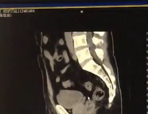 Hình ảnh chụp X quang cho thấy dị vật ở trong trực tràng của người bệnh.