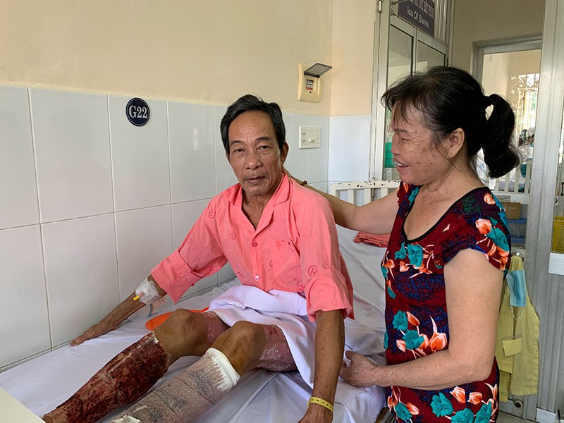 Ông Quảng Trọng Công với vết thương lóc da hai lần ở chân để cứu con. Ảnh: PLO