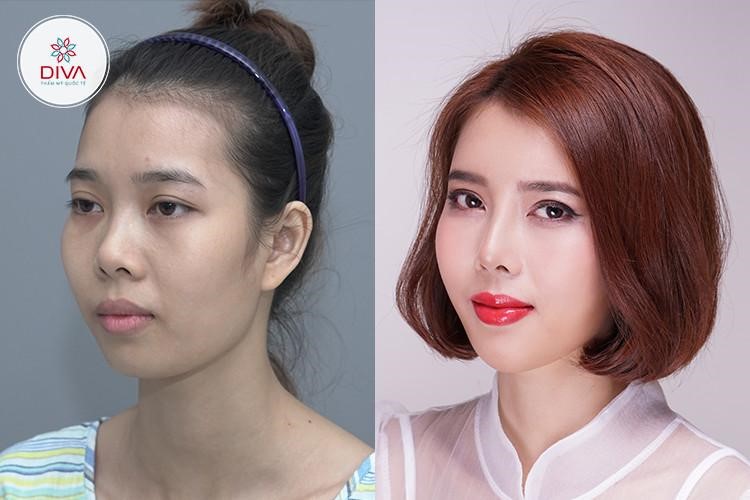 Sau thẩm mỹ, vẫn là chính bạn, nhưng đẹp và thần thái hơn.