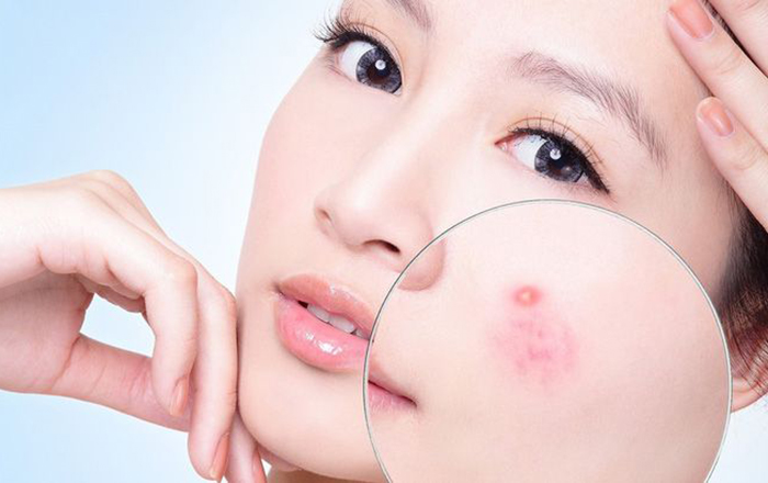 Da mặt nổi mụn cơ thể thiếu hụt vitamin trầm trọng