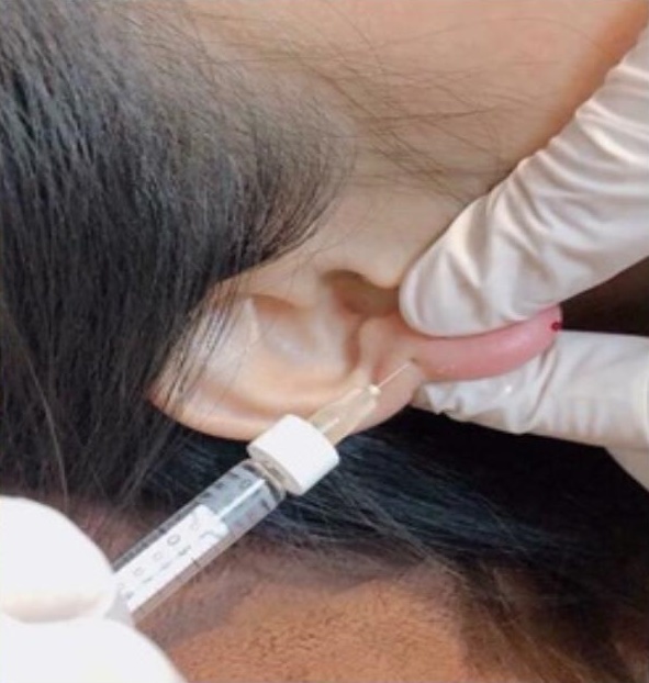 Để tạo dáng tai Phật, người làm sẽ phải tiêm filler vào phần tai. (Ảnh: Sống Khỏe)