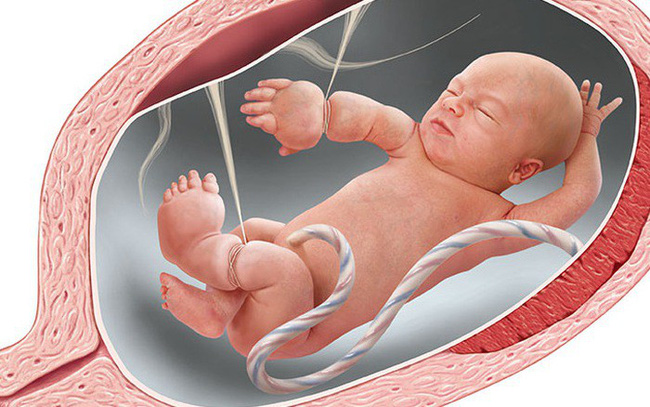 Các dải sợi ối có thể quấn vào thai nhi gây ra hiện tượng vòng thắt bẩm sinh.