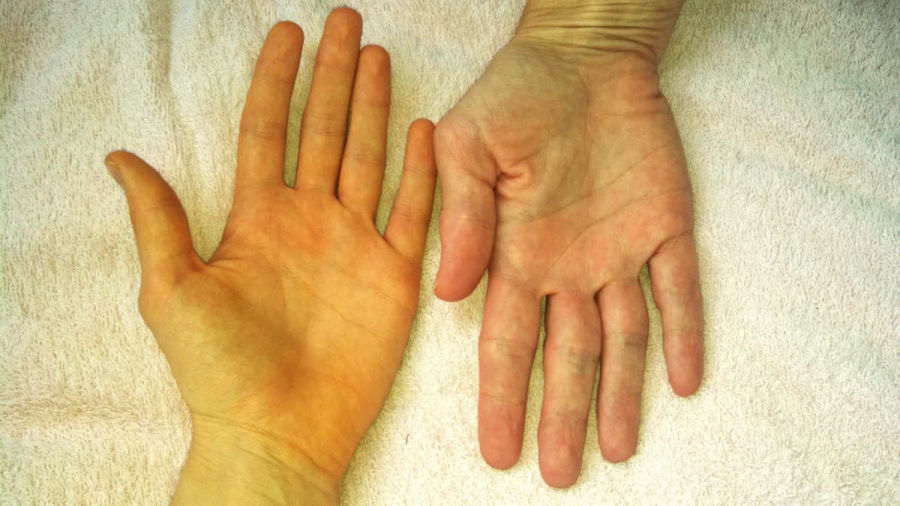 Da có màu vàng chứng tỏ gan bạn đang gặp rối