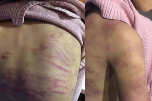 Hình ảnh cháu bé với những vết thương trên cơ thể (Ảnh: Pháp luật& bạn đọc)