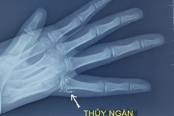 Hình ảnh các hạt thủy ngân trong tay bé Y.