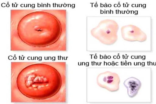 Nguyên nhân chủ yếu gây ra ung thư cổ tử cung là do virus Human Papillomavirus (HPV)