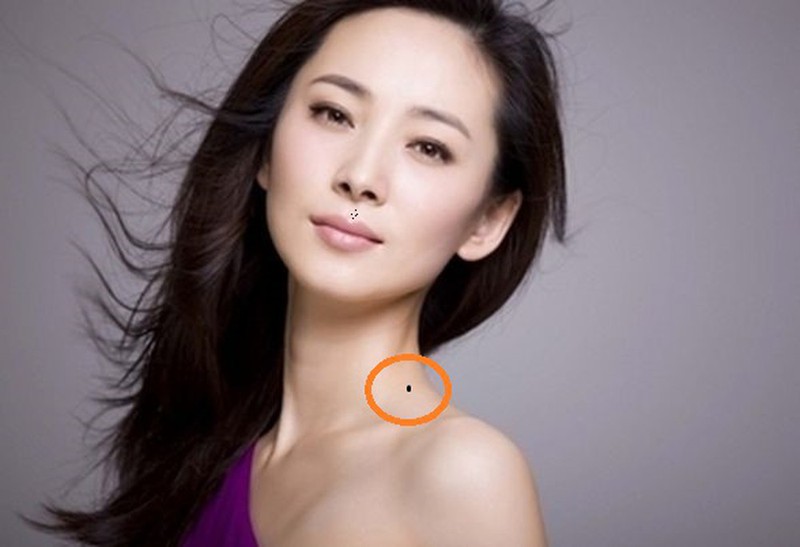Nốt ruồi lận đận