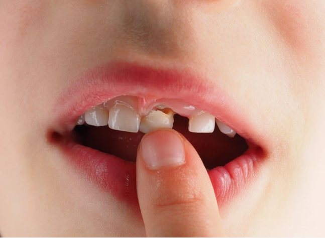 Nên chăm sóc răng miệng cho bé hợp lý