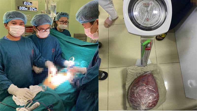 Ca phẫu thuật cắt bỏ khối u 10kg cho bệnh nhân O. diễn ra thành công (Ảnh BV Bạch Mai)