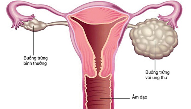 Ung thư buồng trứng là căn bệnh nguy hiểm, xảy ra với bất kỳ độ tuổi (Ảnh minh hoạ)