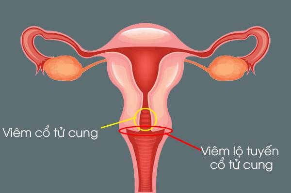 Viêm nhiễn phụ khoa nên đi khám