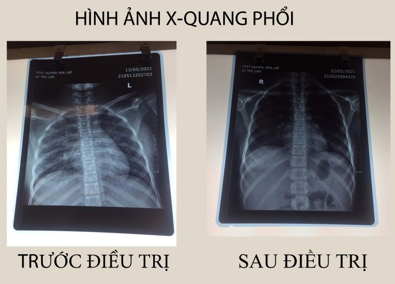 Hình ảnh chụp X quang phổi của bệnh nhân