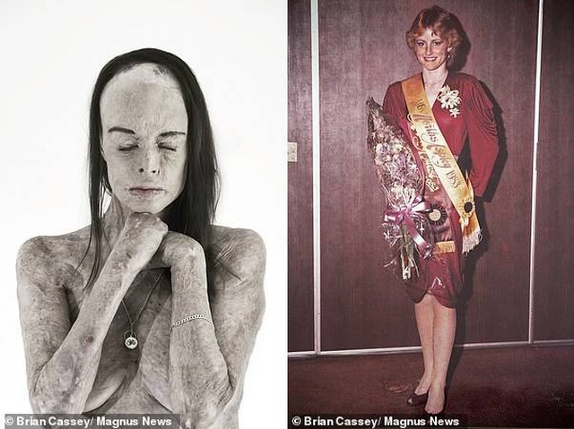 Carol Mayer khi đăng quang hoa hậu (phải) và sau tai nạn (trái)