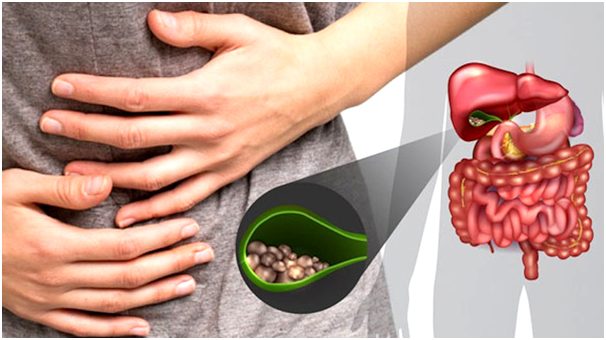 Đau bụng là triệu chứng sỏi mật hay bị nhầm thành bệnh dạ dày