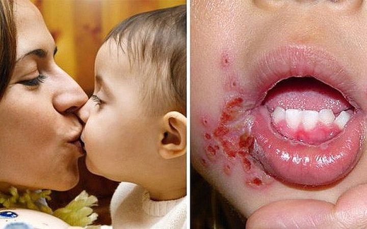 Nụ hôn của người lớn khiến trẻ mắc nhiều bệnh nghiêm trọng