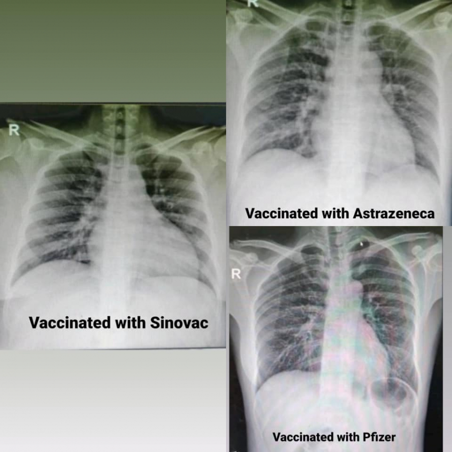 Hình ảnh X-quang cho thấy phổi của 3 bệnh nhân Covid-10 đã được tiêm vắc-xin khác nhau không có quá nhiều sự khác biệt so với người bình thường.
