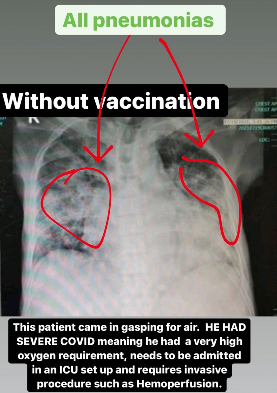 Hình ảnh chụp phổi của bệnh nhân chưa được tiêm vắc-xin với những vùng xơ hóa.