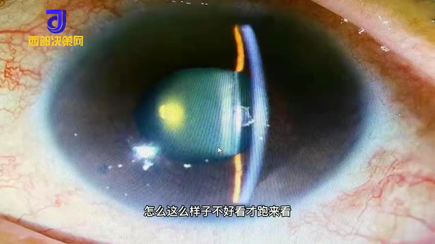 Đồng tử trong mắt phải của Xiaoya gần như chuyển sang màu trắng 