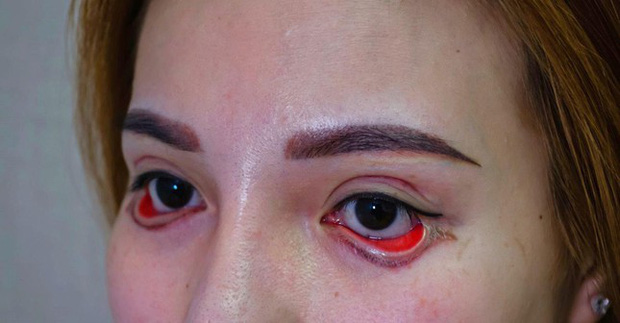 Mắt của bệnh nhân sau phẫu thuật cắt mí tại cơ sở thẩm mỹ ở địa phương