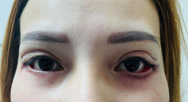 Đôi mắt được phục hồi sau phẫu thuật tại bệnh viện