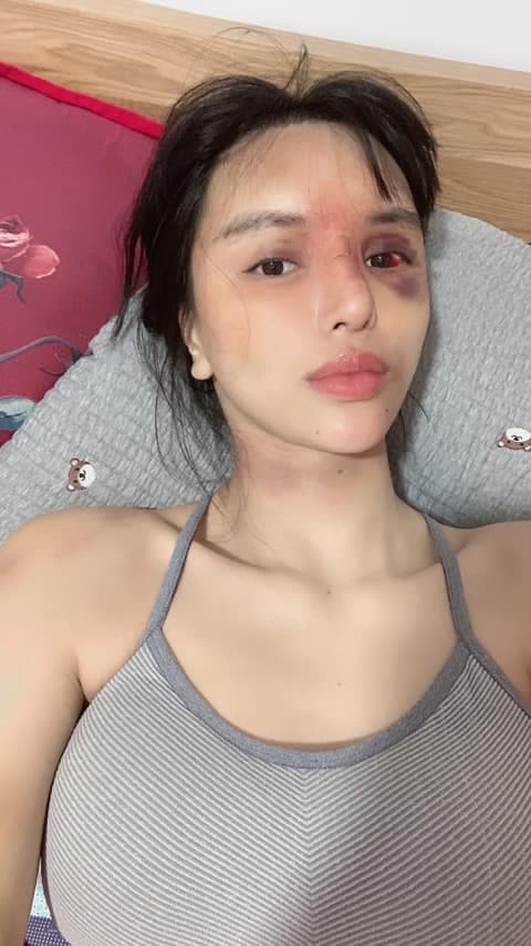 Siêu mẫu Khả Trang lộ diện sau khi tiết lộ bị bạo hành, khuôn mặt vẫn sưng và tụ máu