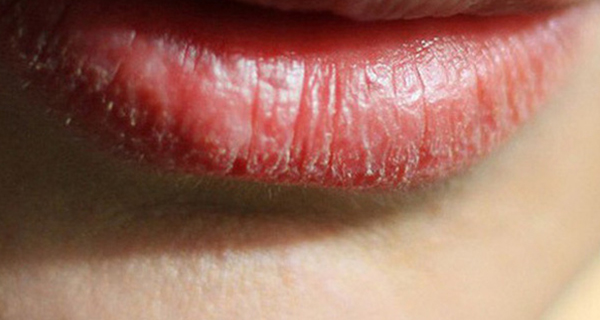Người có gan xấu thường có 4 biểu hiện trên môi, 'dính' trên 2 cái là cần đi viện gấp