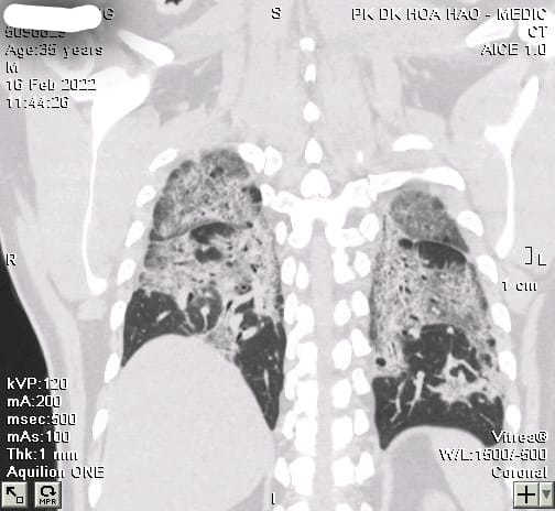 Hình ảnh phổi của bệ.nh nhân trắng xoá do xơ phổi tiến triển hậu Covid-19.