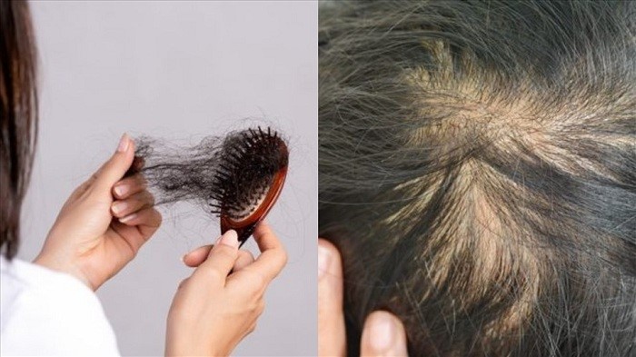 Rụng tóc nhiều ở nam có sao không Cách khắc phục thế nào  Nhà thuốc FPT  Long Châu