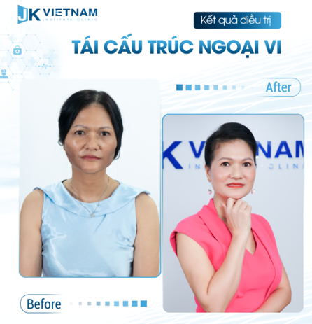 Chị Thảo chẳng ngại đường xá xa xôi, vất vả đã đến với JK Việt Nam thực hiện làm đầy má hóp